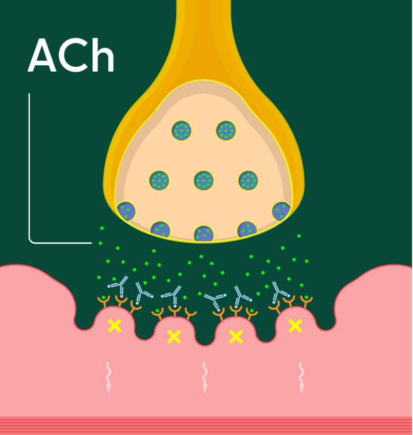 neuromuscular junction with Ach antibodies attaching to muscle receptors