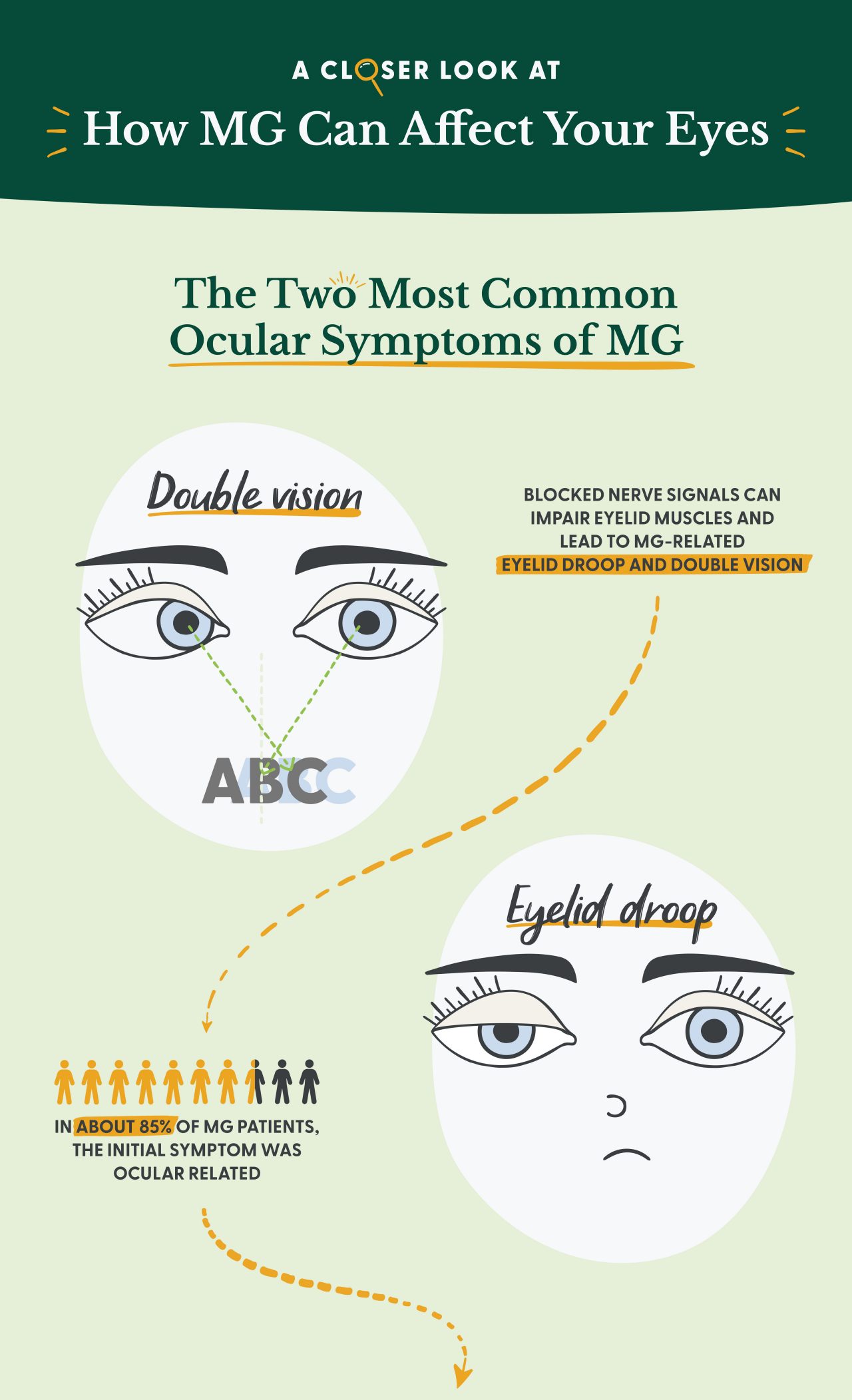 This graphic portrays the two most common ocular symptoms of MG. Double vision, or diplopia, means you see two images of a single object. And eyelid droop, or ptosis, means your upper eyelid (or eyelids) covers part of your eye. It has a fact that states, “Blocked nerve signals can impair eyelid muscles and lead to MG-related eyelid droop and double vision.” It also has a stat which says, “In about 85% of MG patients, the initial symptom was ocular related.”