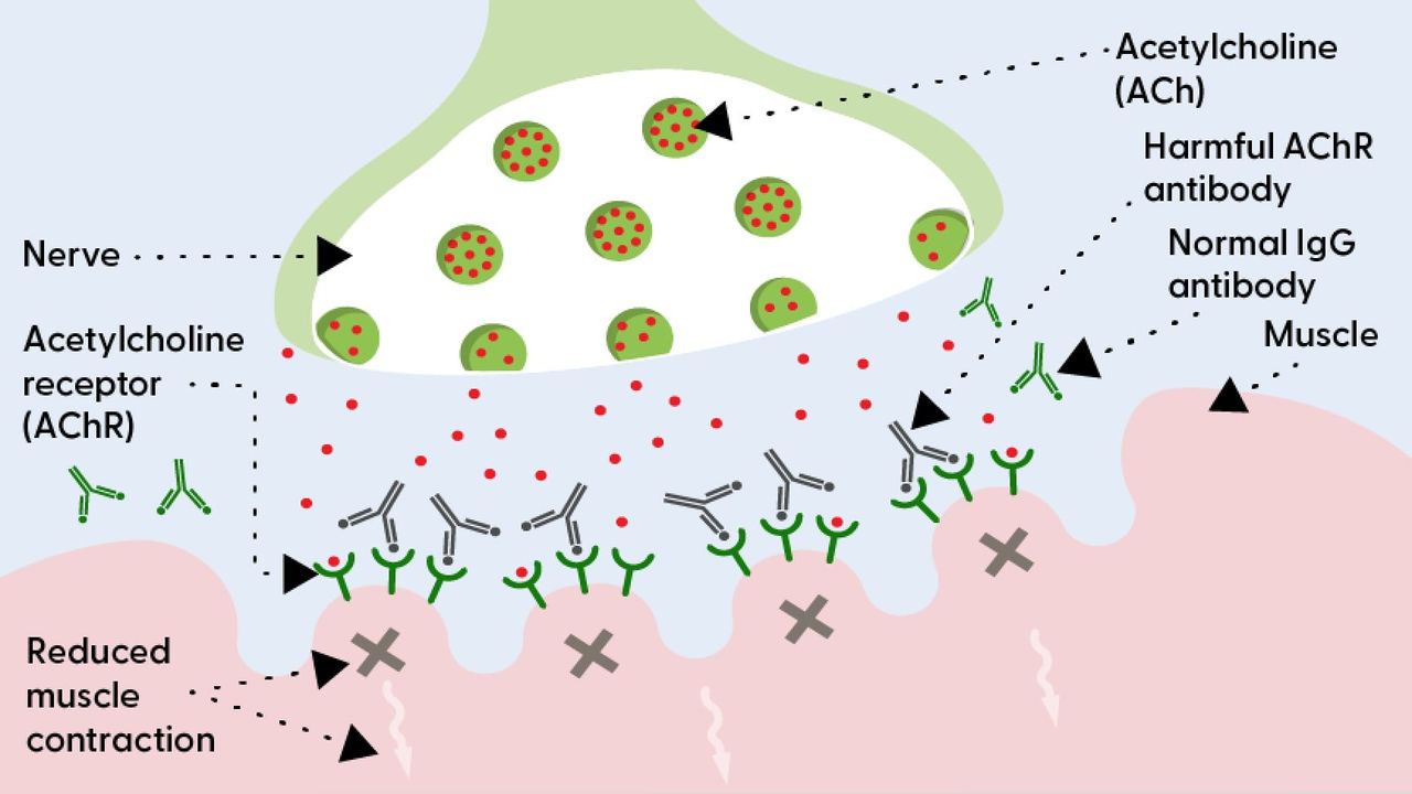 The neuromuscular junction with MG